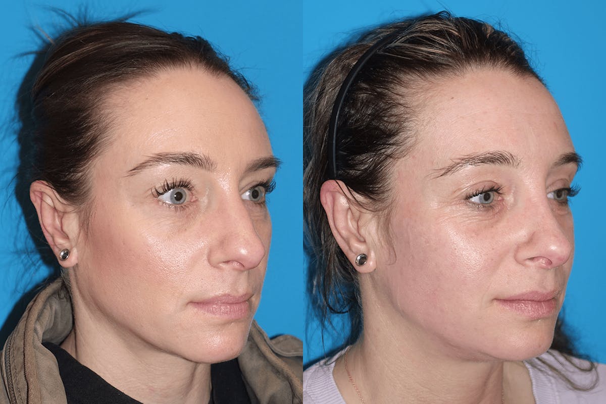 Rhinoplasty Before & After Gallery - Patient 972076 - Image 3