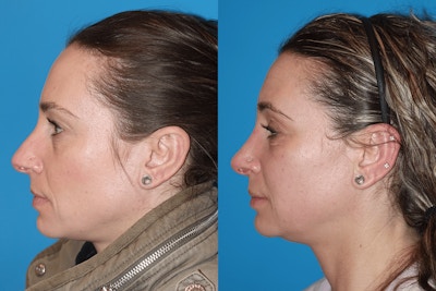 Rhinoplasty Before & After Gallery - Patient 972076 - Image 1