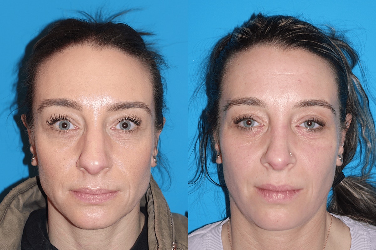 Rhinoplasty Before & After Gallery - Patient 317688 - Image 3