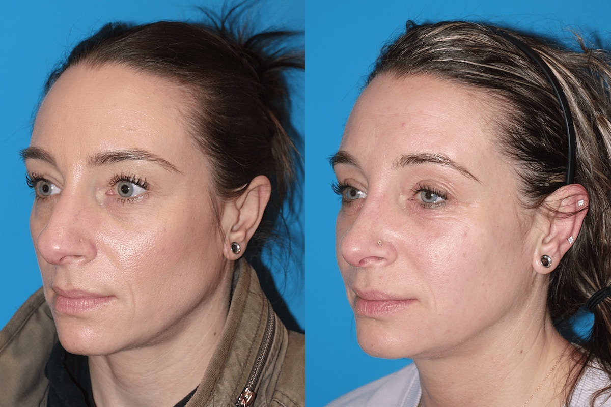 Rhinoplasty Before & After Gallery - Patient 317688 - Image 4