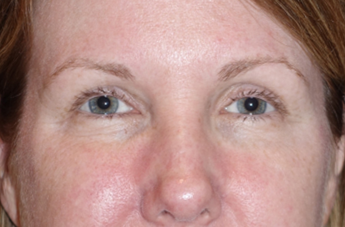 Eyelid Lift- Lower Before & After Gallery - Patient 389674 - Image 1