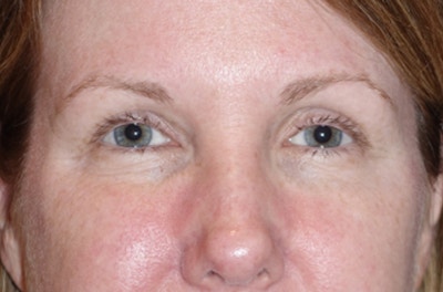 Eyelid Lift- Lower Before & After Gallery - Patient 389674 - Image 1