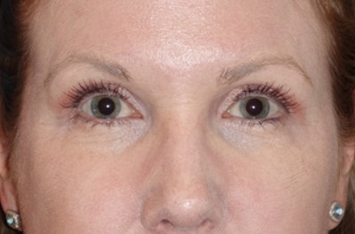 Eyelid Lift- Lower Before & After Gallery - Patient 389674 - Image 2