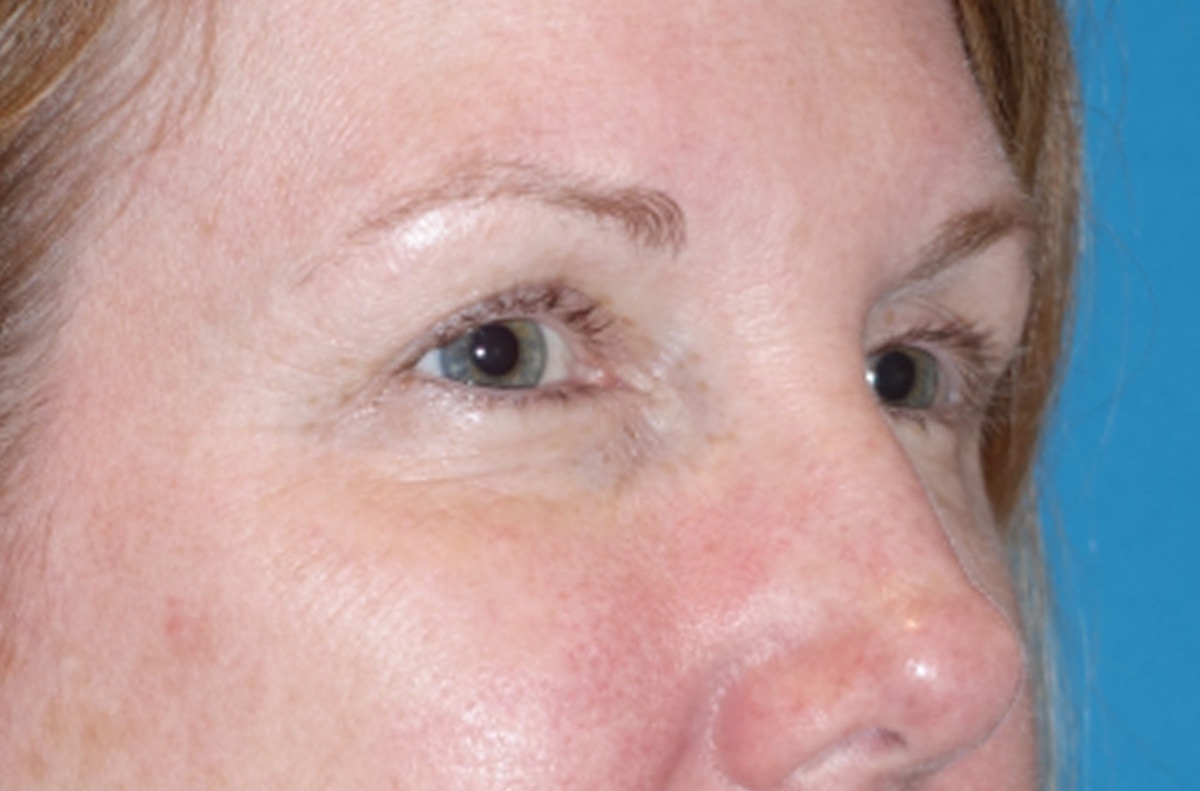 Eyelid Lift- Lower Before & After Gallery - Patient 389674 - Image 3
