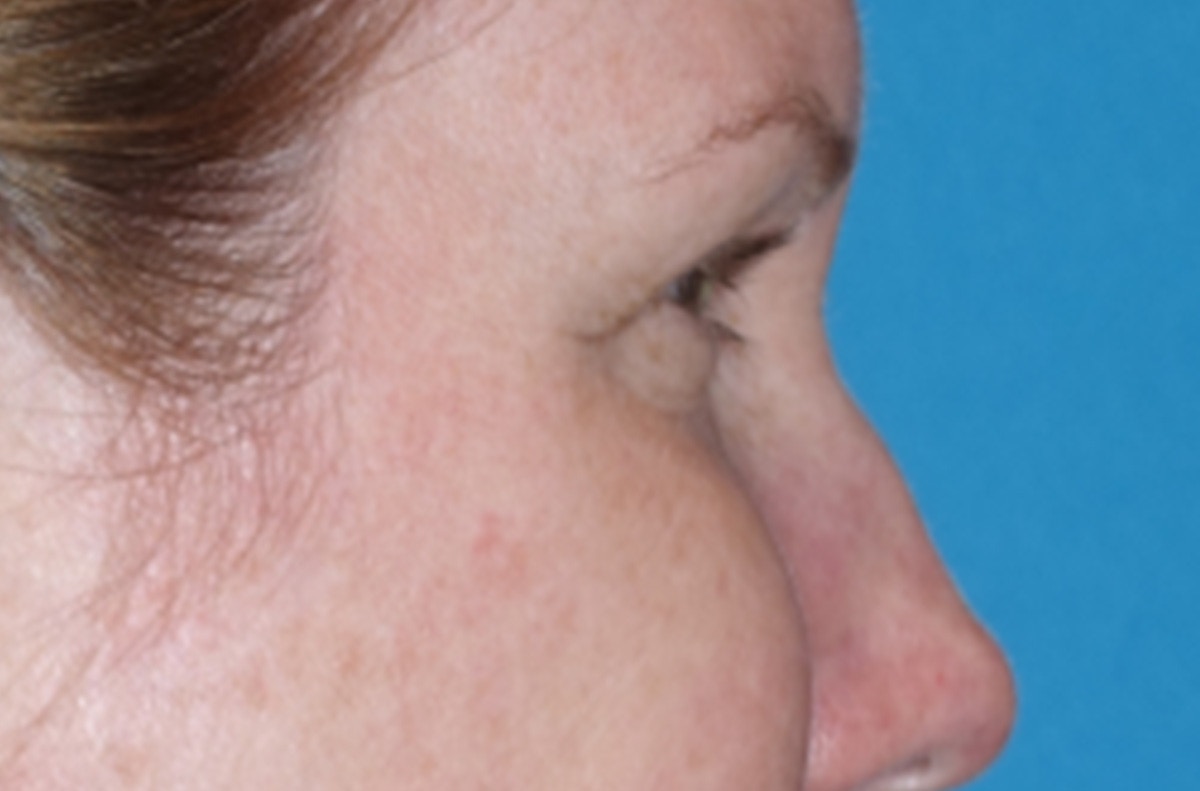 Eyelid Lift- Lower Before & After Gallery - Patient 389674 - Image 5