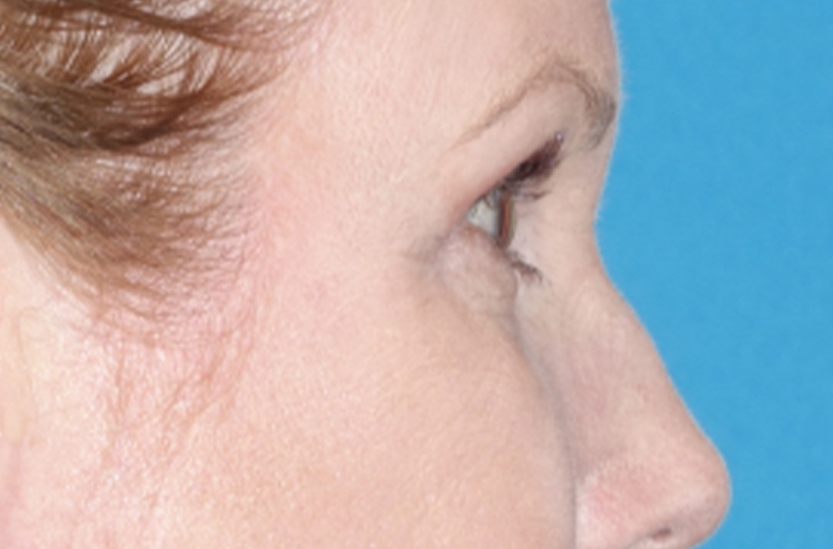 Eyelid Lift- Lower Before & After Gallery - Patient 389674 - Image 6