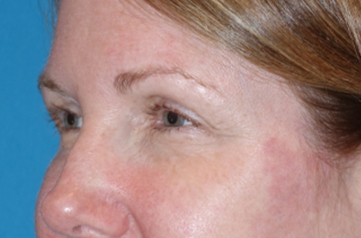Eyelid Lift- Lower Before & After Gallery - Patient 389674 - Image 7
