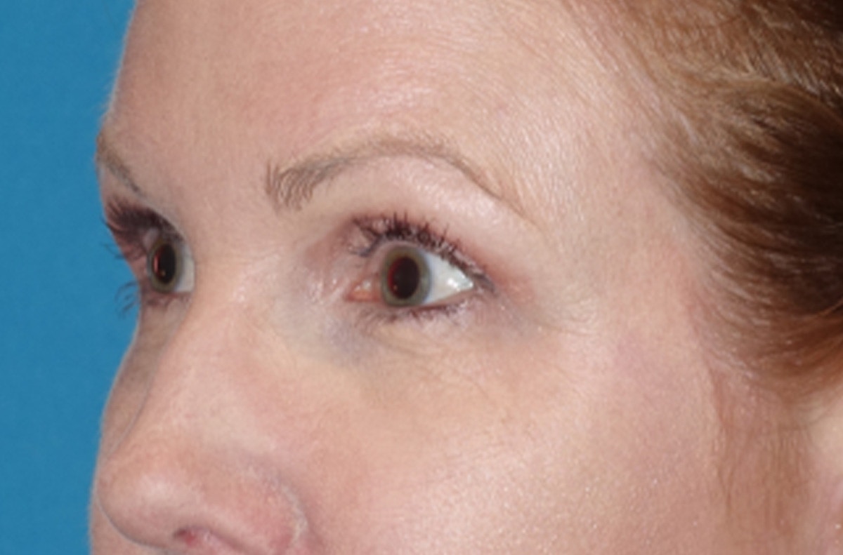 Eyelid Lift- Lower Before & After Gallery - Patient 389674 - Image 8