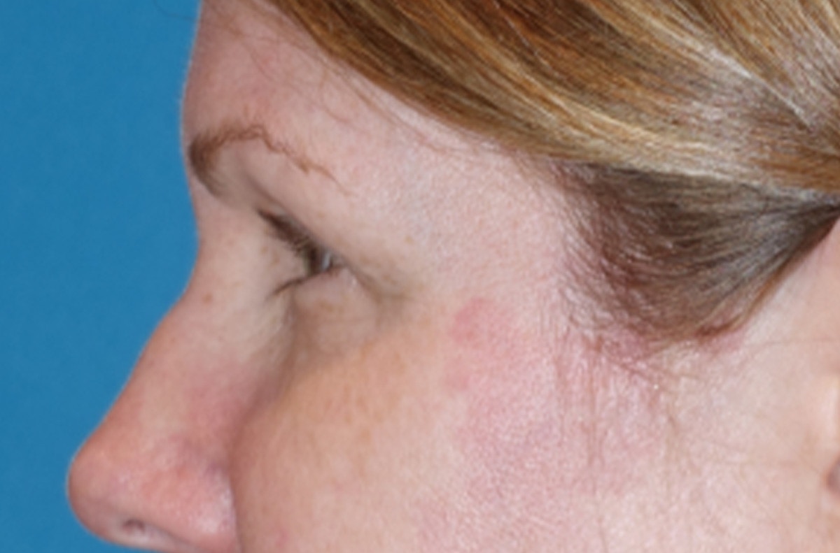 Eyelid Lift- Lower Before & After Gallery - Patient 389674 - Image 9