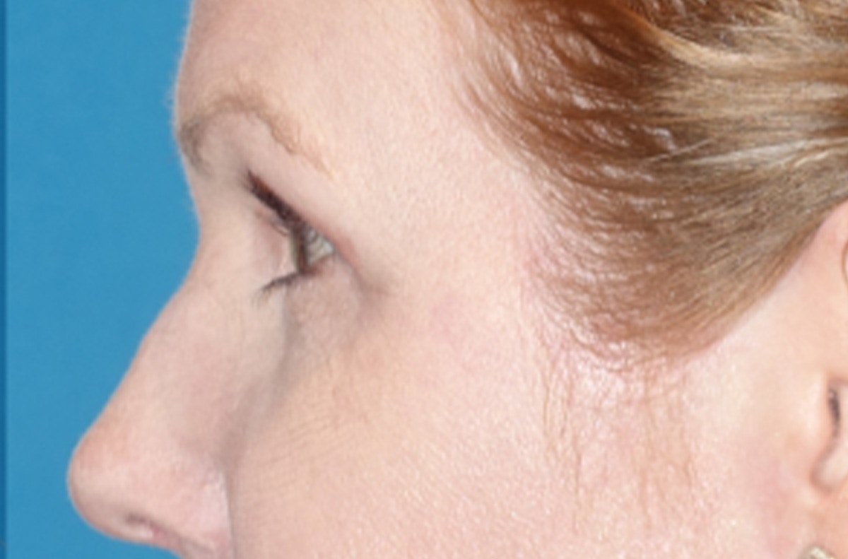 Eyelid Lift- Lower Before & After Gallery - Patient 389674 - Image 10