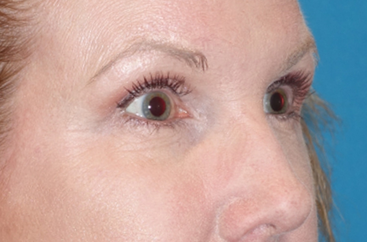 Eyelid Lift- Lower Before & After Gallery - Patient 389674 - Image 4