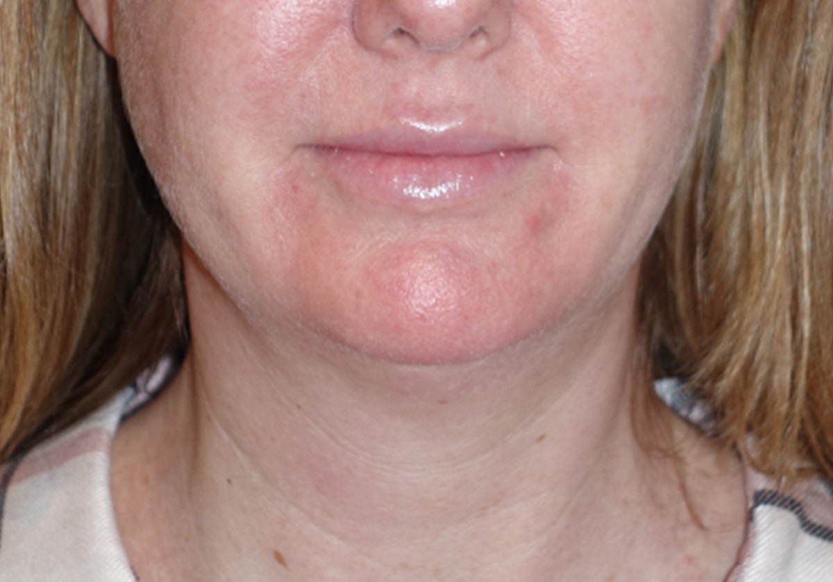 Neck Lift Before & After Gallery - Patient 336190 - Image 5