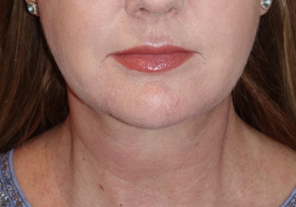 Neck Lift Before & After Gallery - Patient 336190 - Image 6