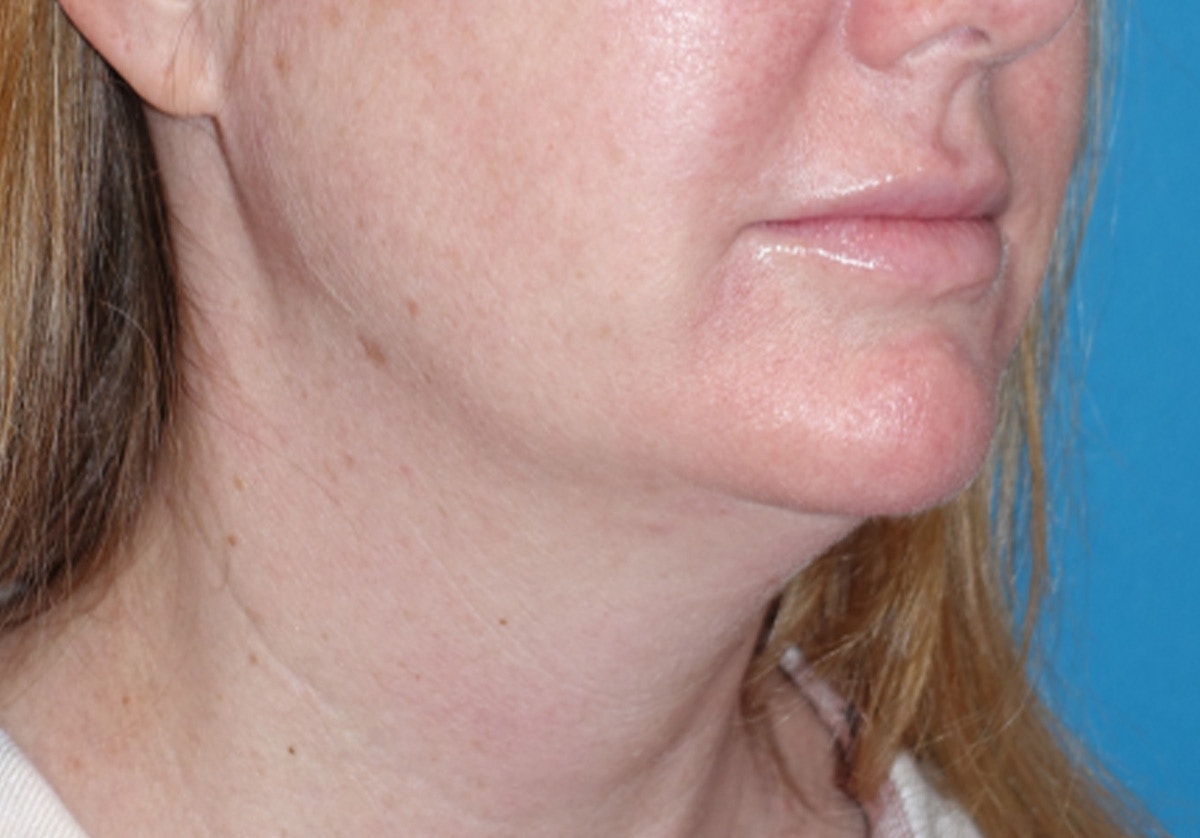 Neck Lift Before & After Gallery - Patient 336190 - Image 1