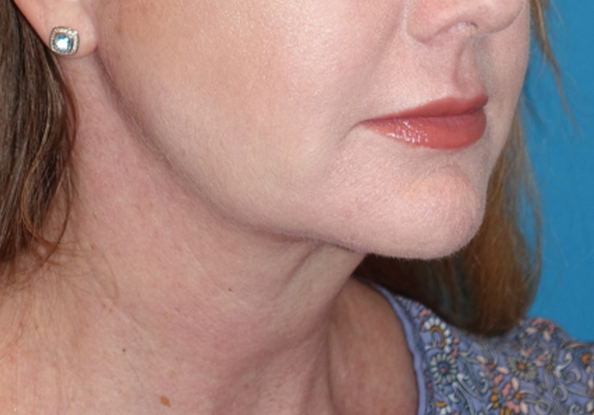 Neck Lift Before & After Gallery - Patient 336190 - Image 2
