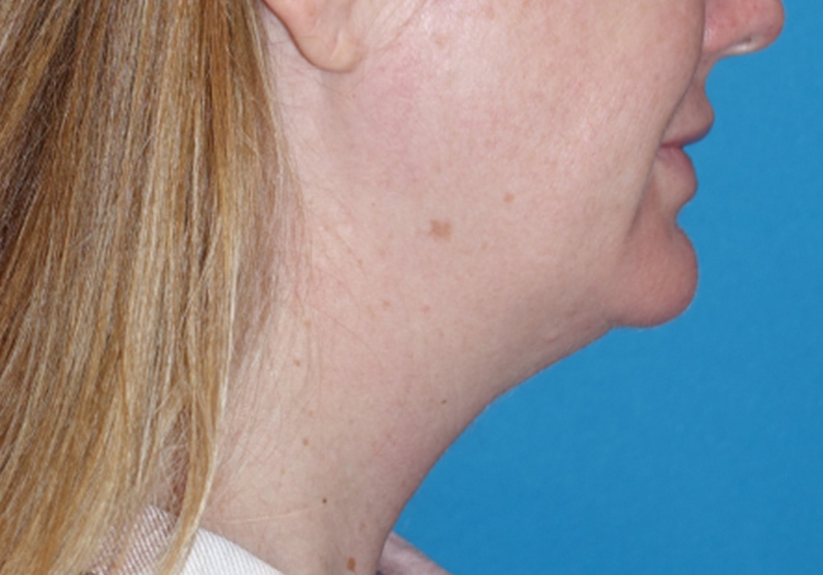 Neck Lift Before & After Gallery - Patient 336190 - Image 3
