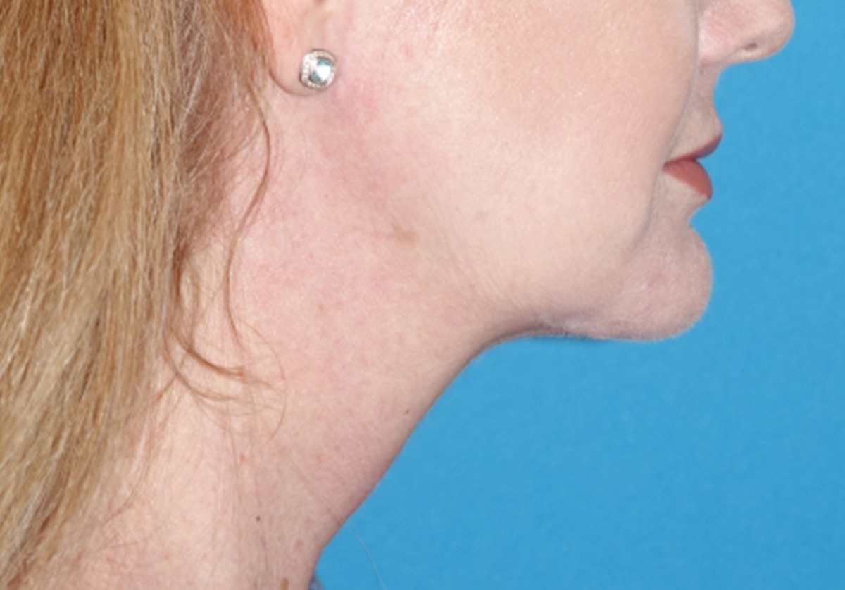 Neck Lift Before & After Gallery - Patient 336190 - Image 4