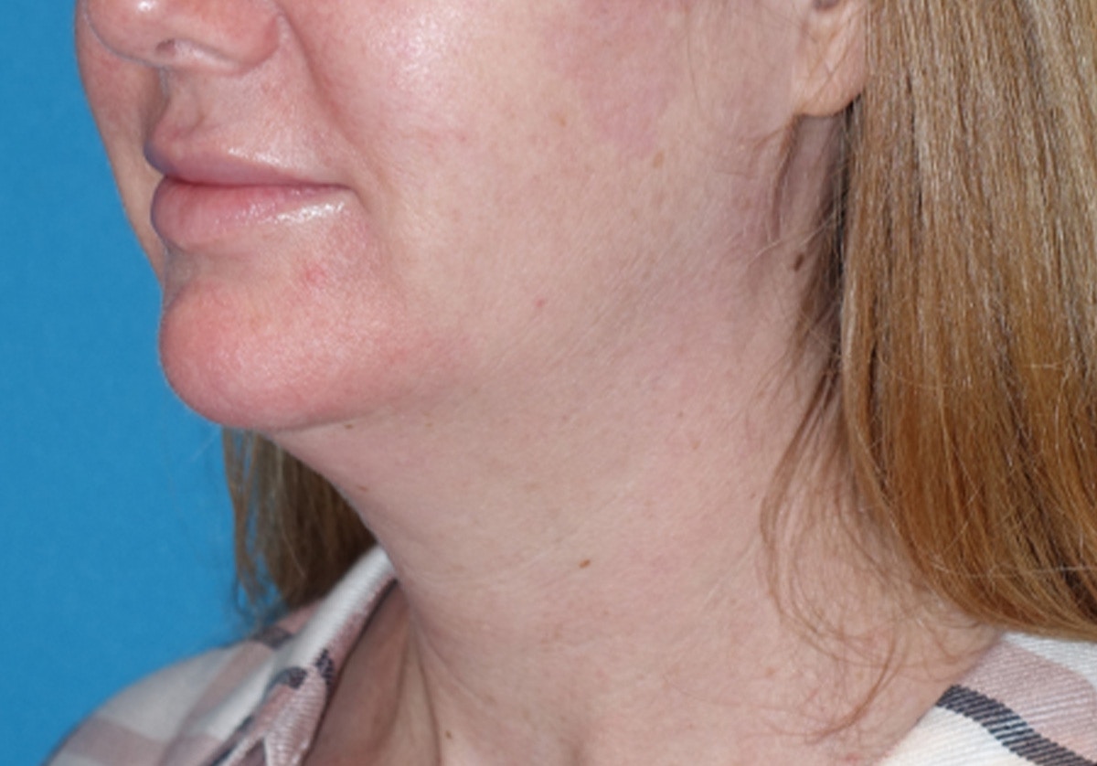 Neck Lift Before & After Gallery - Patient 336190 - Image 7