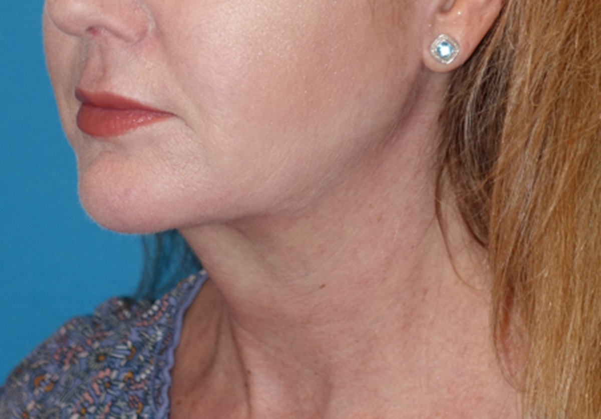 Neck Lift Before & After Gallery - Patient 336190 - Image 8