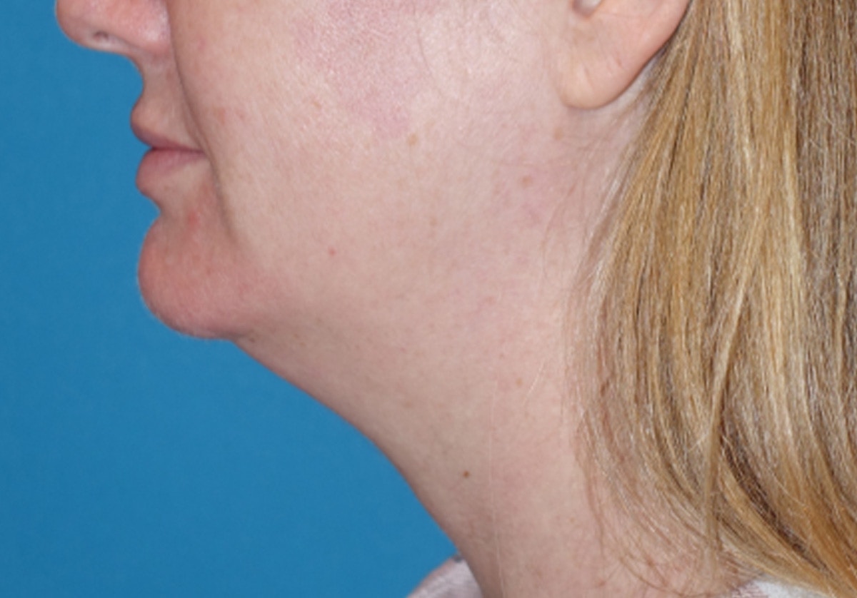 Neck Lift Before & After Gallery - Patient 336190 - Image 9