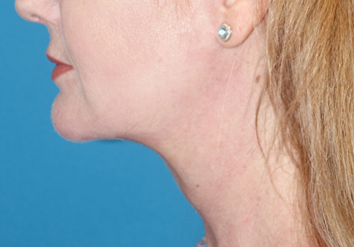 Neck Lift Before & After Gallery - Patient 336190 - Image 10