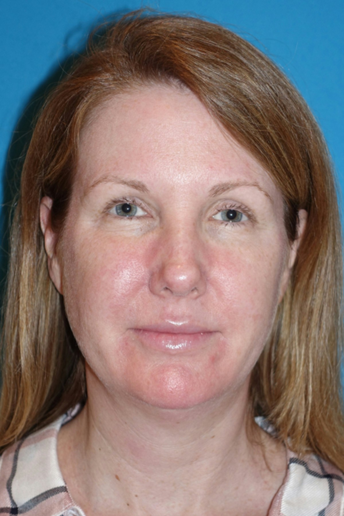 Morpheus8 Before & After Gallery - Patient 393318 - Image 1
