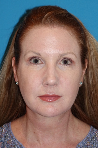 Morpheus8 Before & After Gallery - Patient 393318 - Image 2
