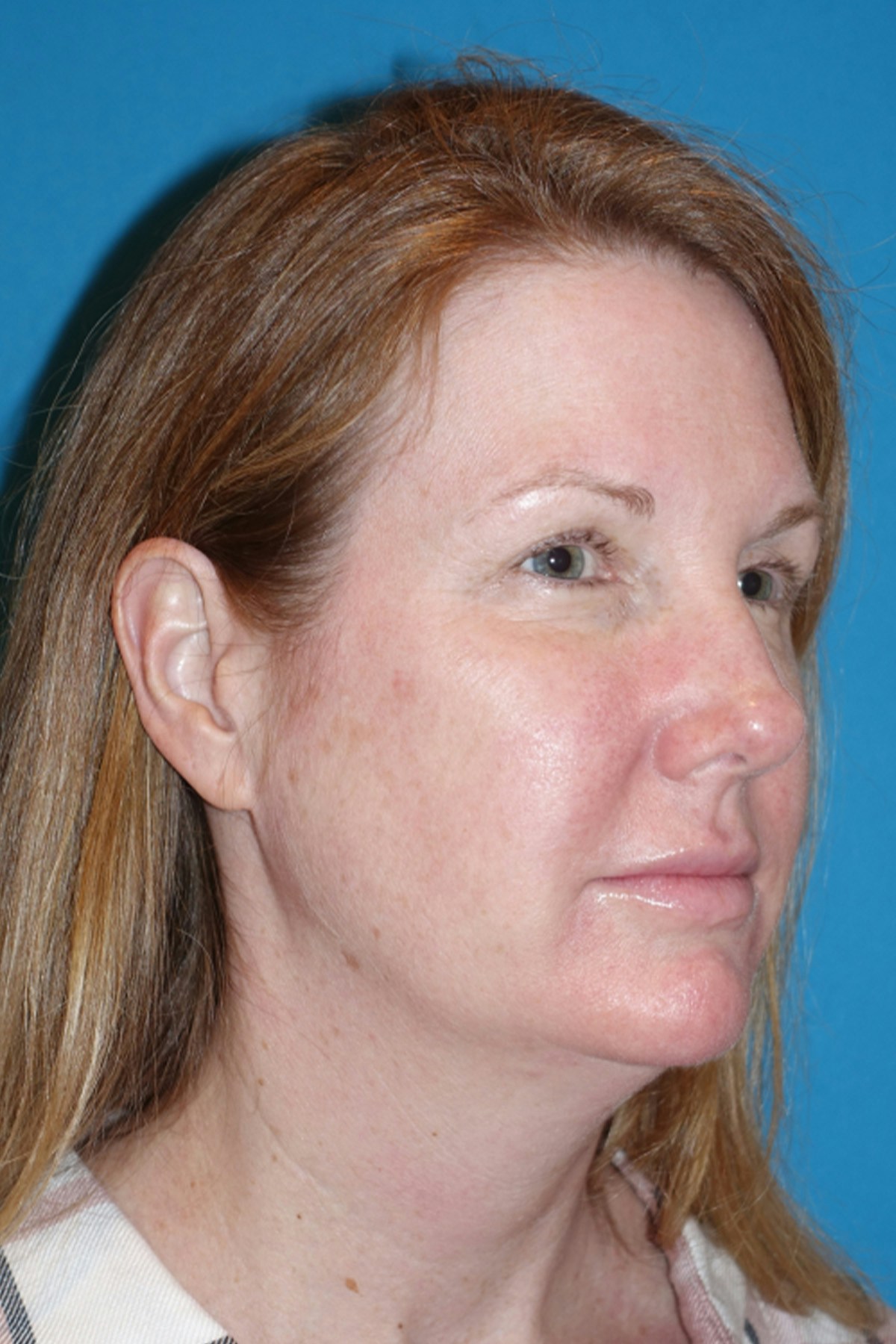 Morpheus8 Before & After Gallery - Patient 393318 - Image 3