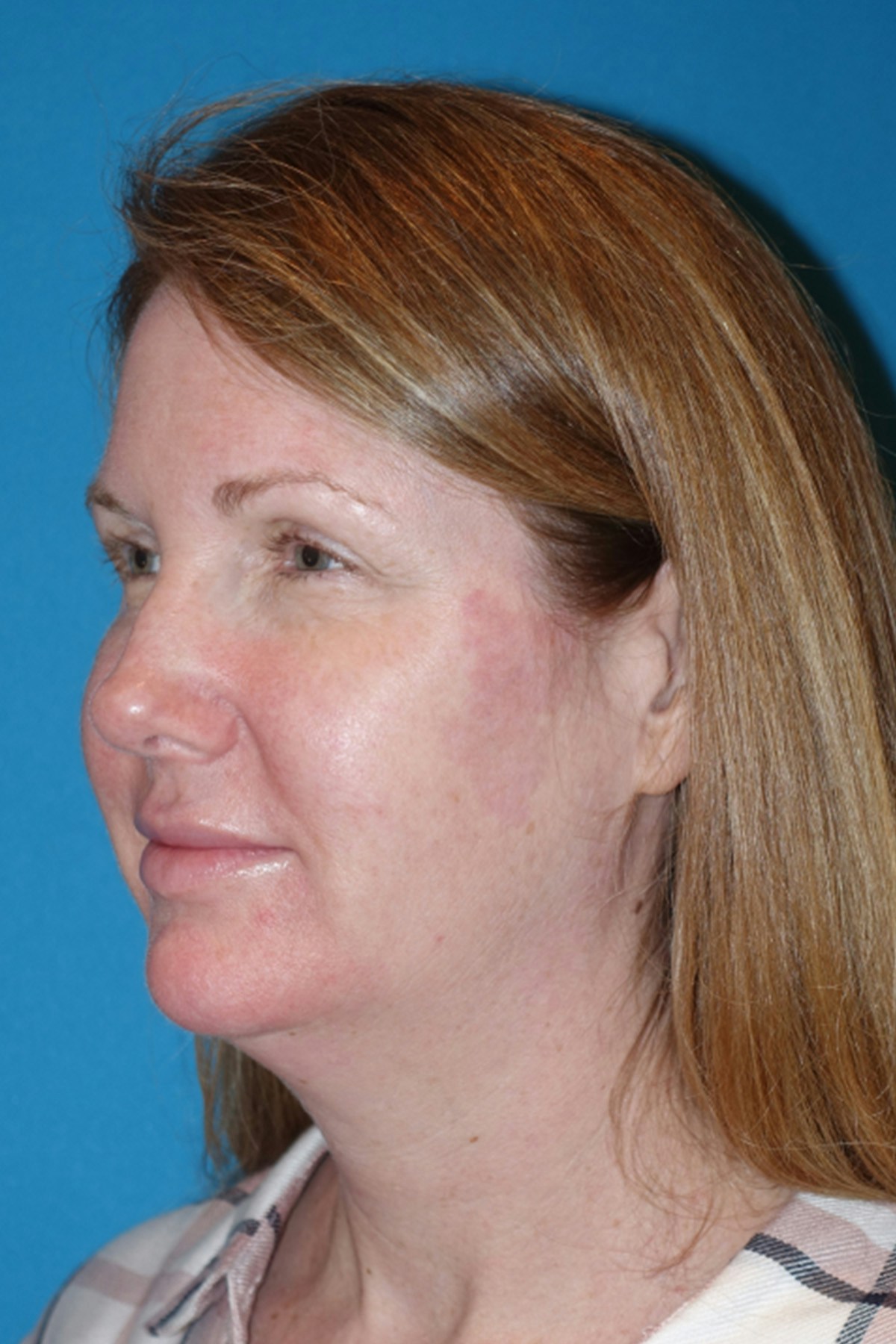 Morpheus8 Before & After Gallery - Patient 393318 - Image 7