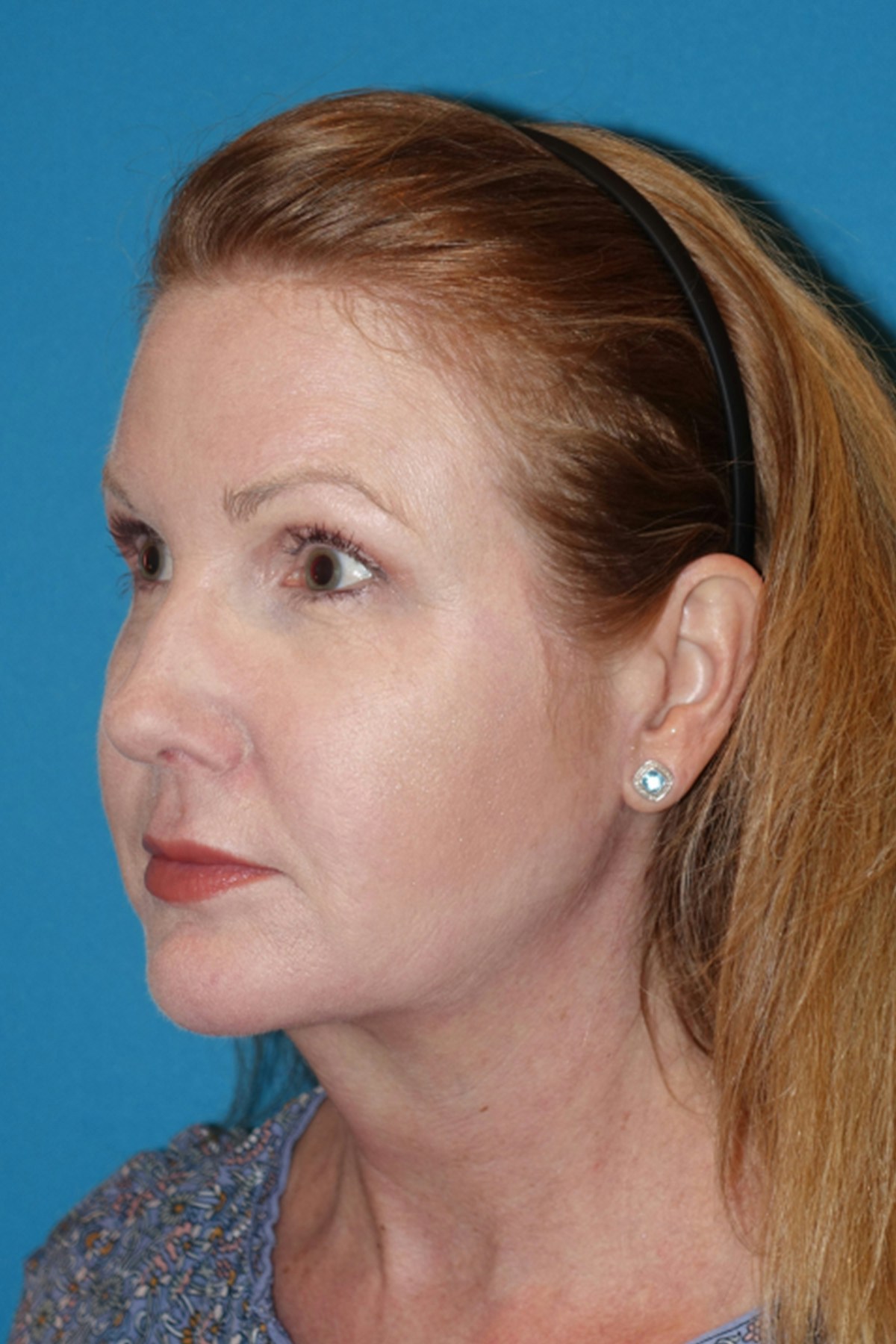 Morpheus8 Before & After Gallery - Patient 393318 - Image 8