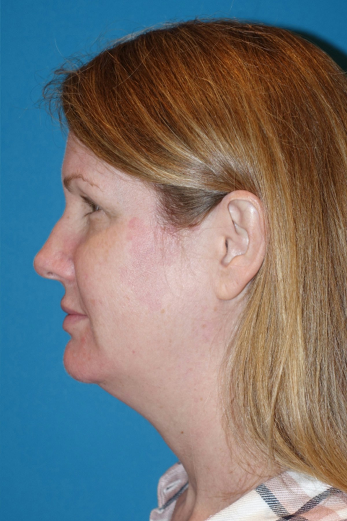 Morpheus8 Before & After Gallery - Patient 393318 - Image 9