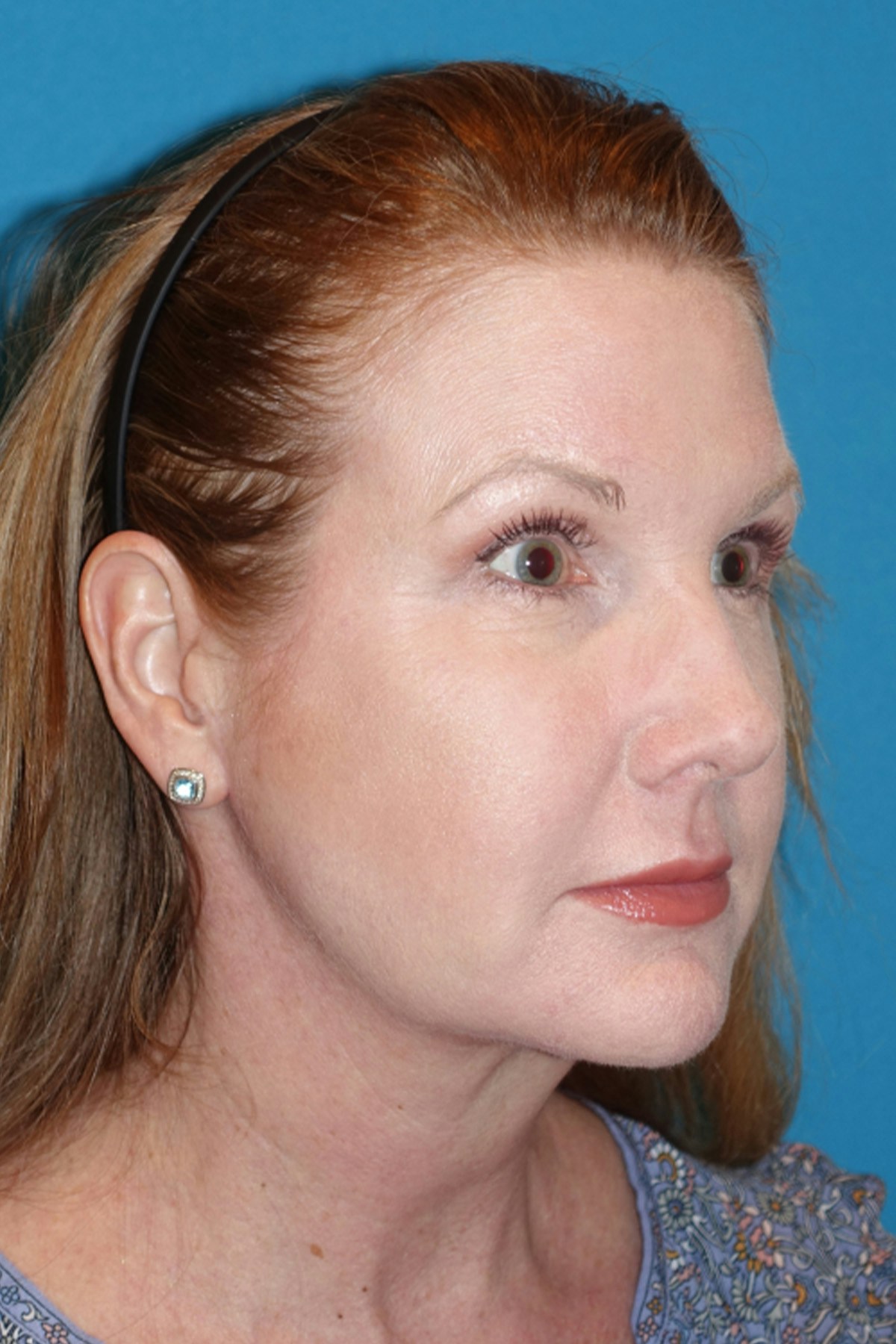 Morpheus8 Before & After Gallery - Patient 393318 - Image 4