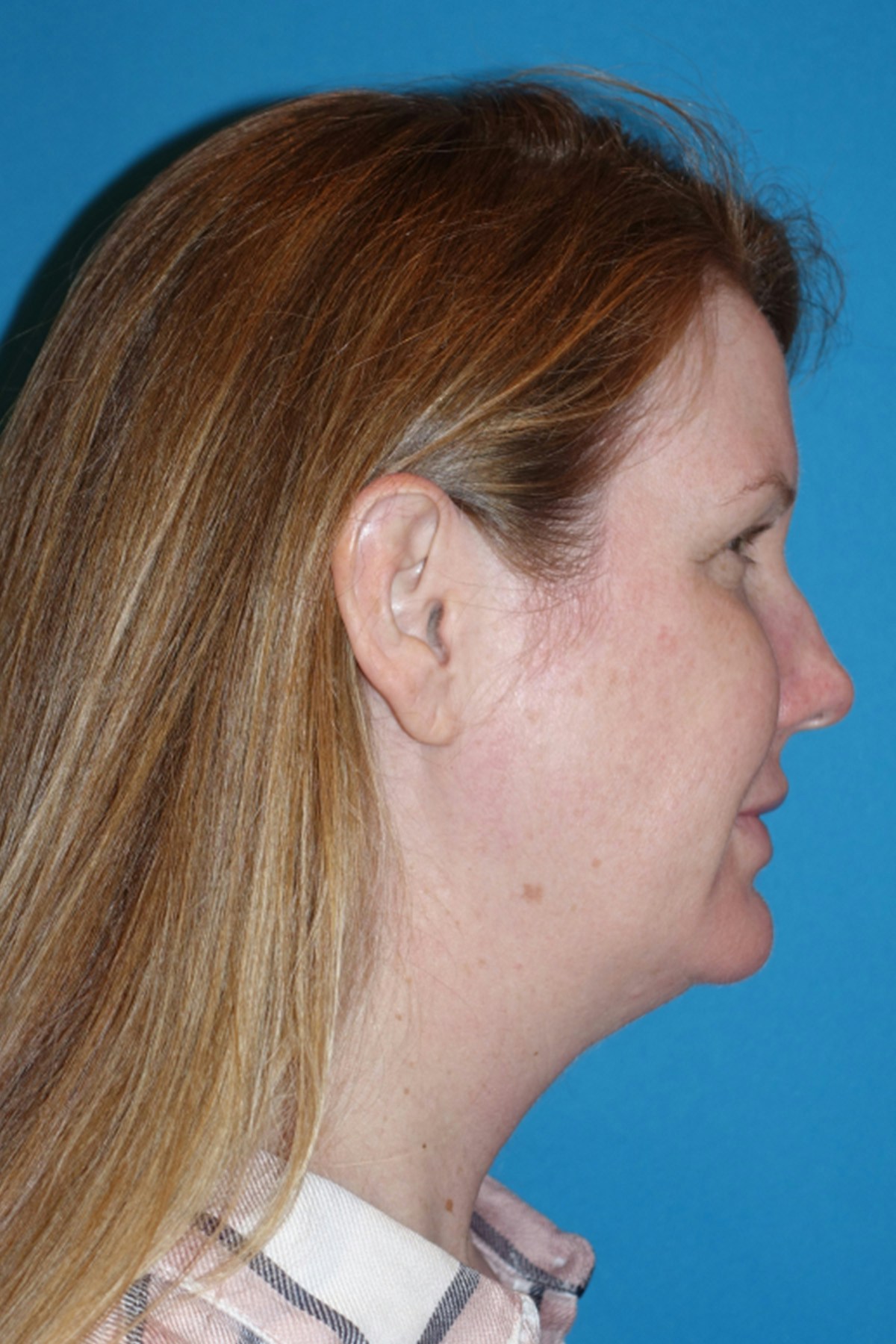 Morpheus8 Before & After Gallery - Patient 393318 - Image 5