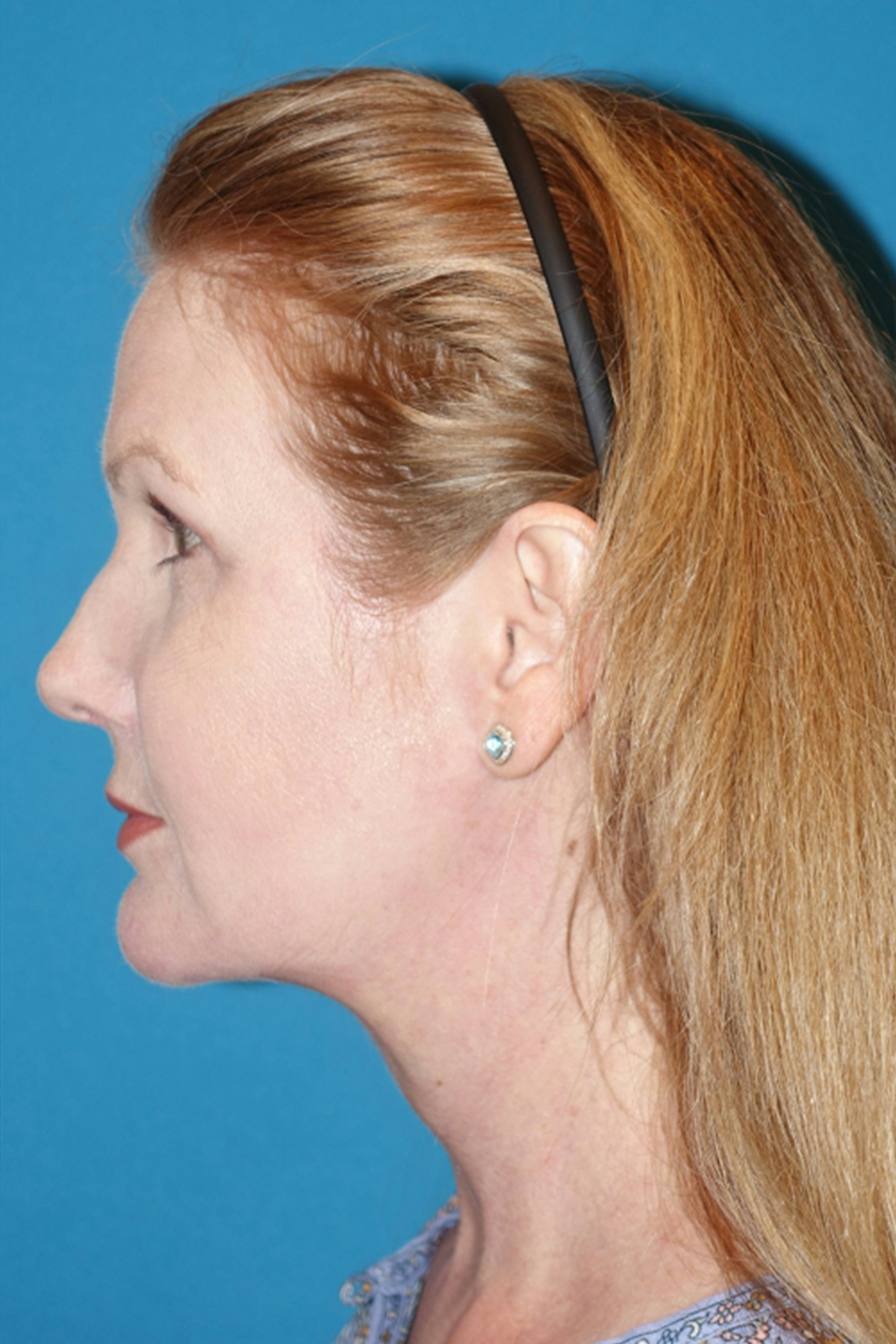 Morpheus8 Before & After Gallery - Patient 393318 - Image 10