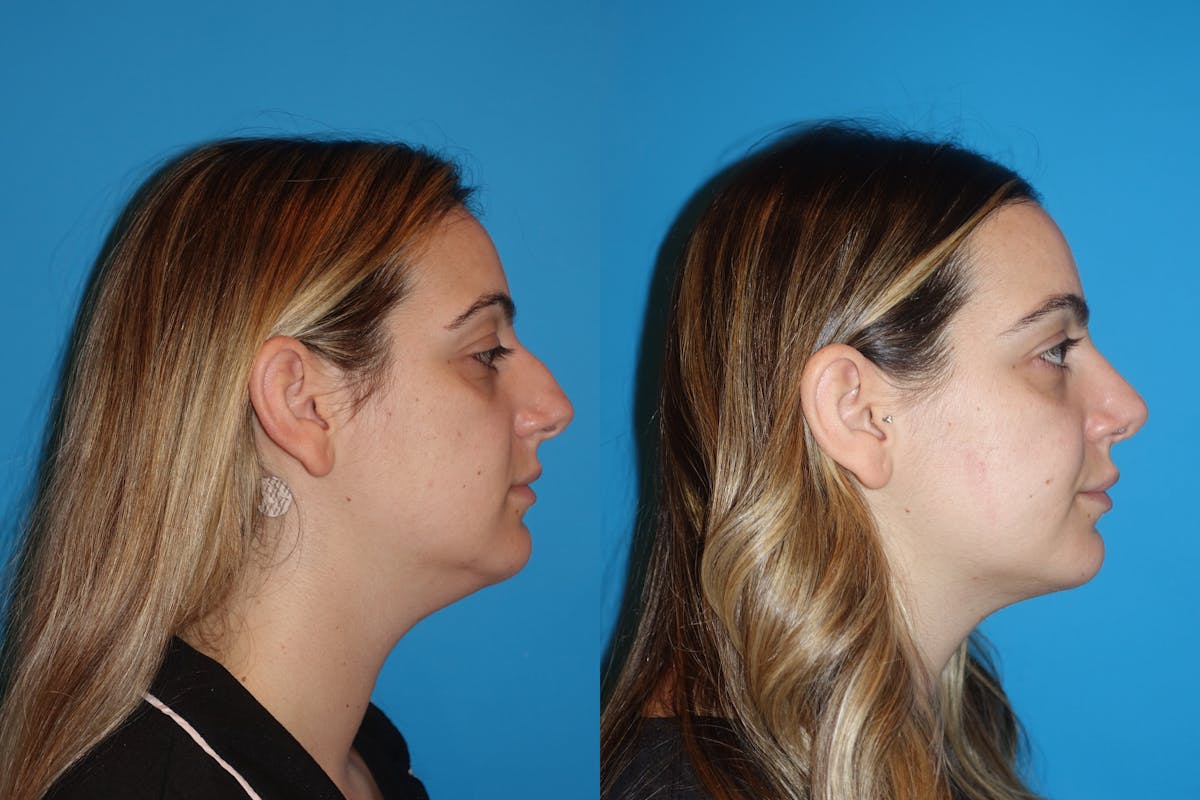 Neck Liposuction Before & After Gallery - Patient 130213 - Image 5