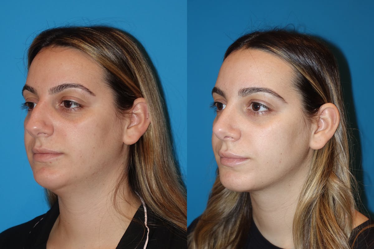 Neck Liposuction Before & After Gallery - Patient 130213 - Image 2