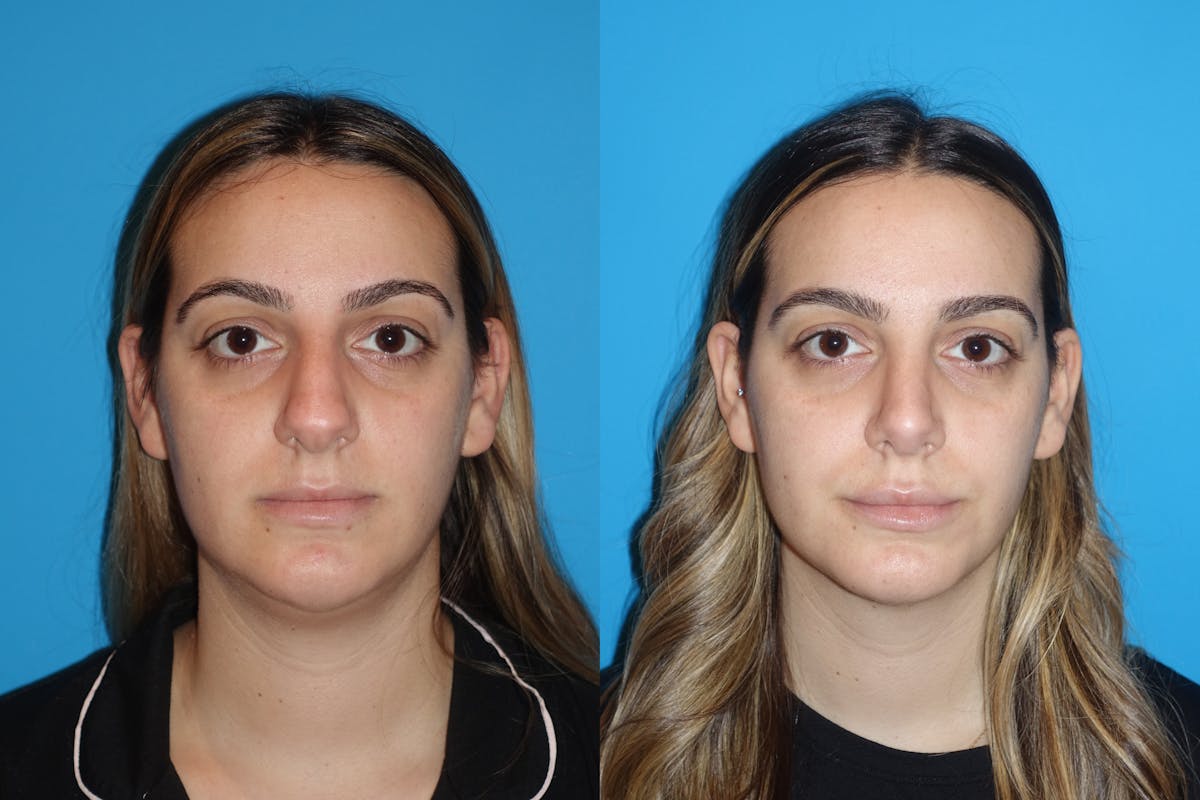 Neck Liposuction Before & After Gallery - Patient 130213 - Image 3