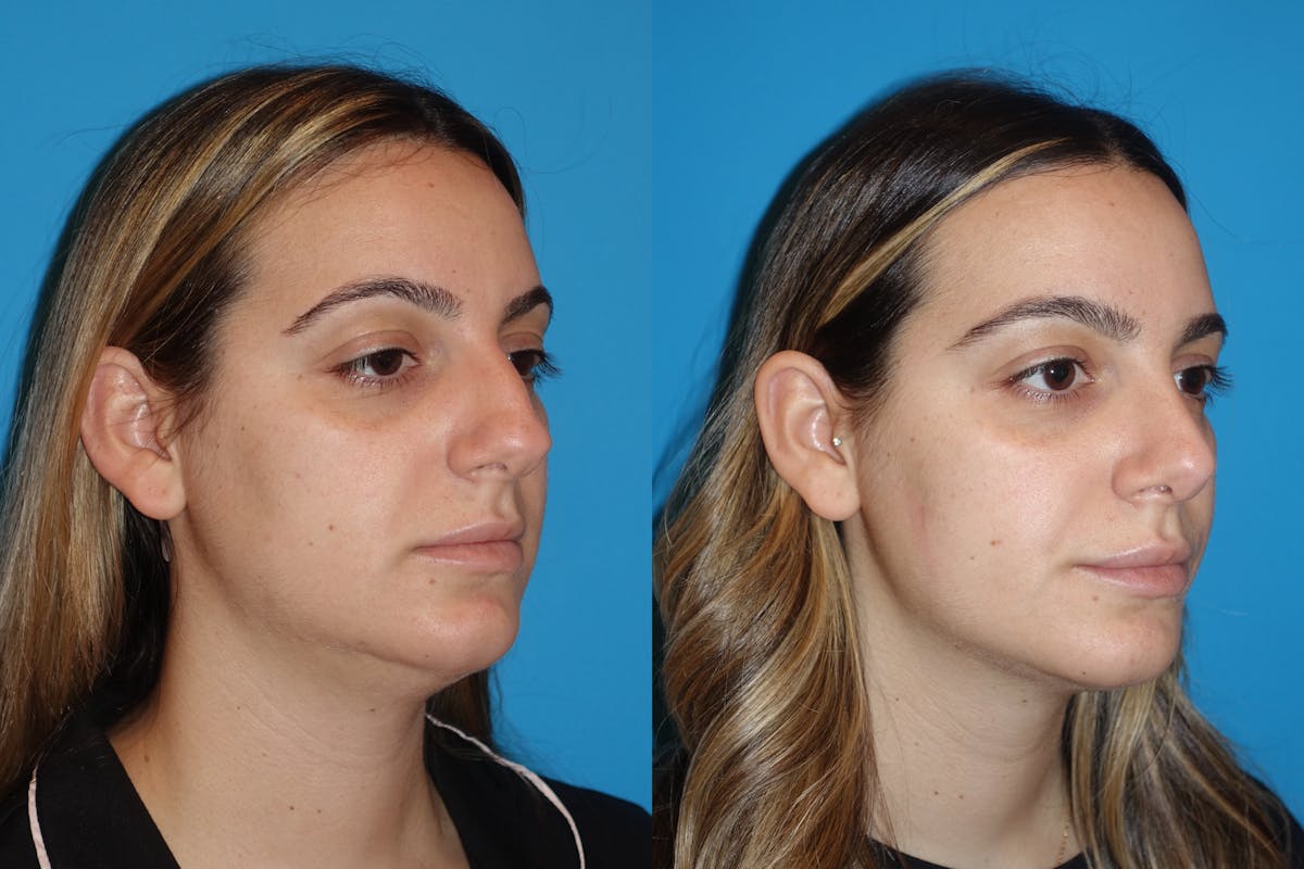 Neck Liposuction Before & After Gallery - Patient 130213 - Image 4