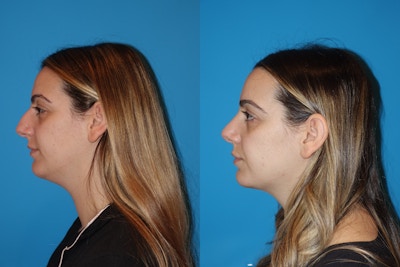 Neck Liposuction Before & After Gallery - Patient 130213 - Image 1