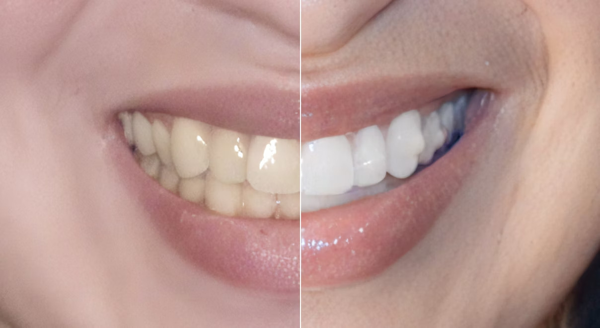 FXBright Aligners Difference Without and With | OrthoFX
