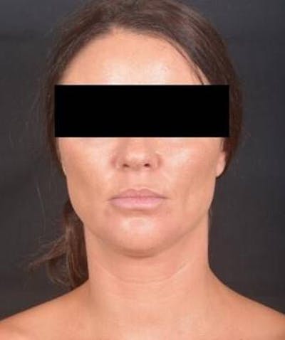 Neck Liposuction Before & After Gallery - Patient 217109 - Image 1