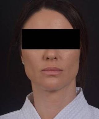 Neck Liposuction Before & After Gallery - Patient 217109 - Image 2