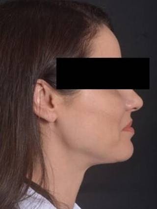 Neck Liposuction Before & After Gallery - Patient 217109 - Image 6