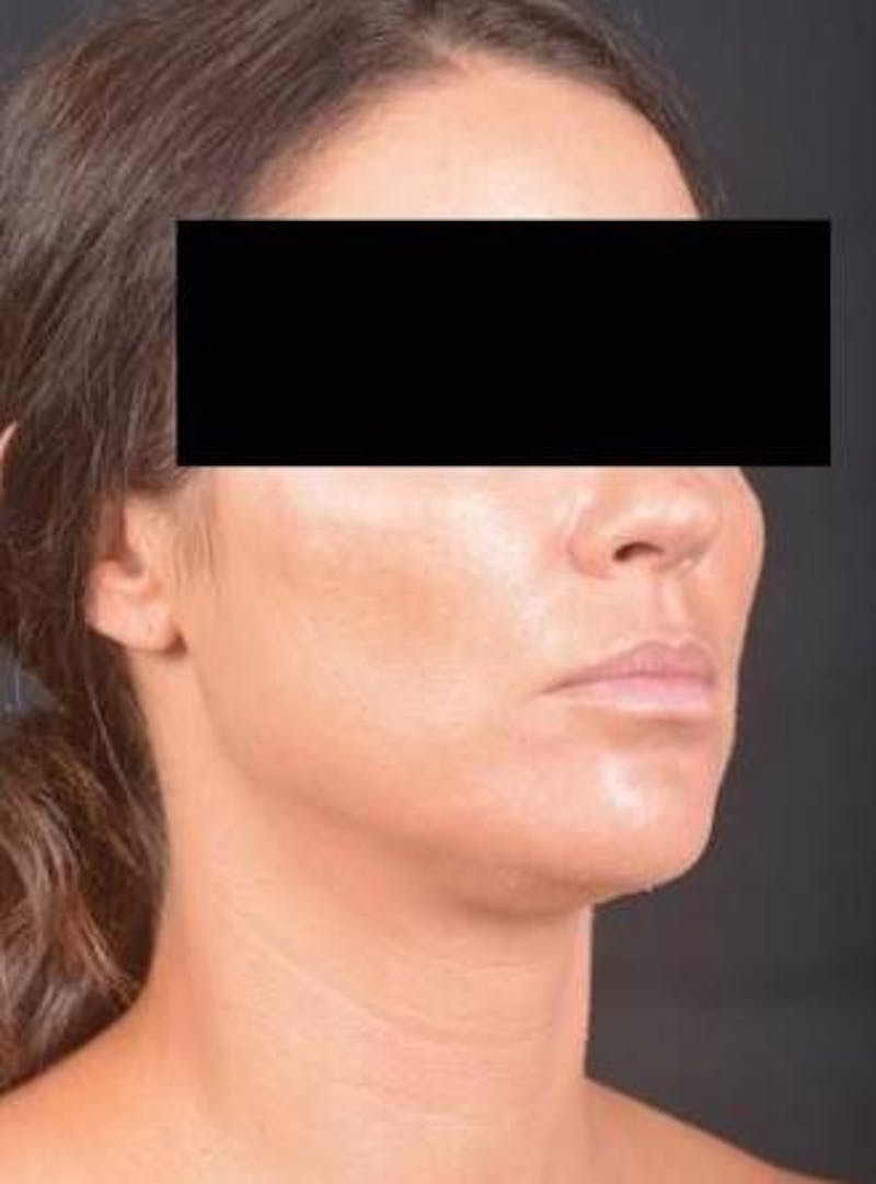 Neck Liposuction Before & After Gallery - Patient 217109 - Image 9