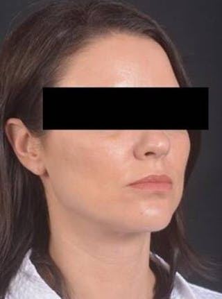 Neck Liposuction Before & After Gallery - Patient 217109 - Image 10