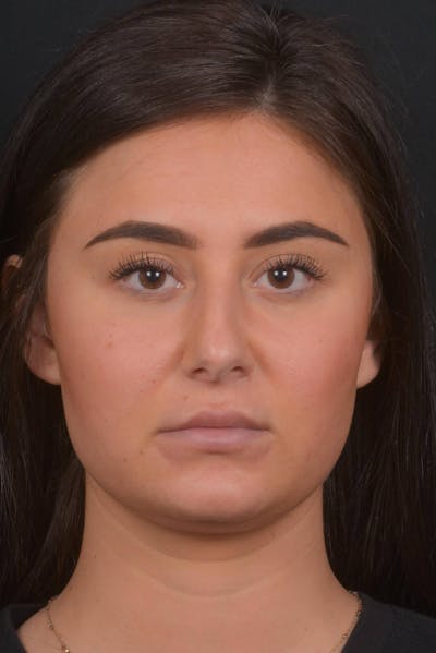 Neck Liposuction Before & After Gallery - Patient 393276 - Image 1