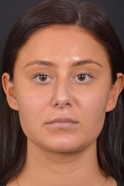 Neck Liposuction Before & After Gallery - Patient 393276 - Image 2