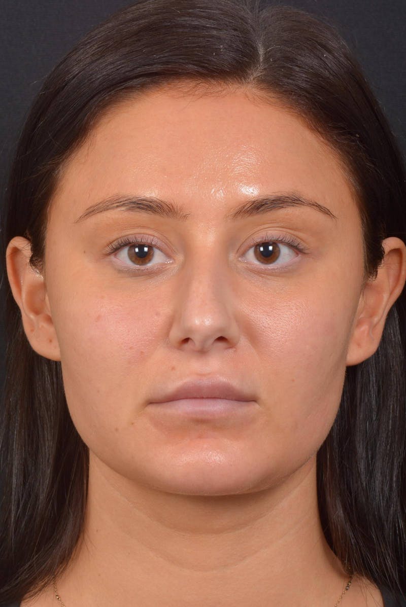 Neck Liposuction Before & After Gallery - Patient 393276 - Image 2