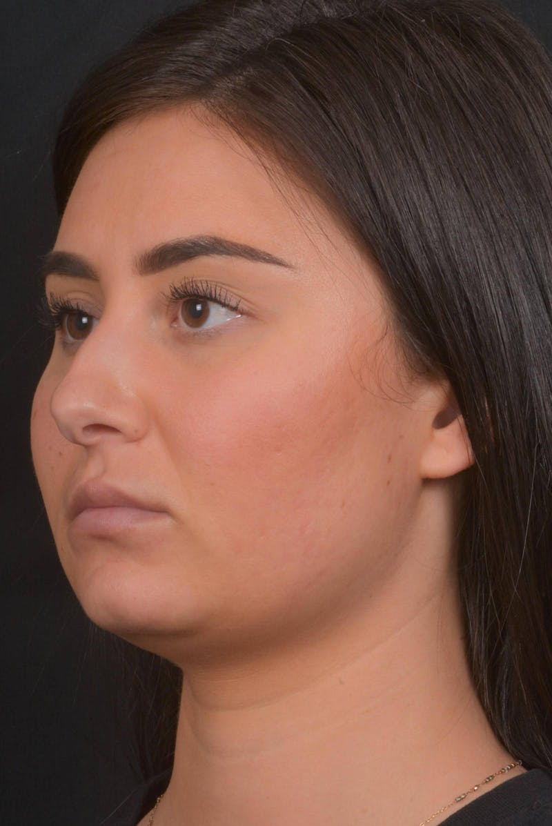 Neck Liposuction Before & After Gallery - Patient 393276 - Image 7