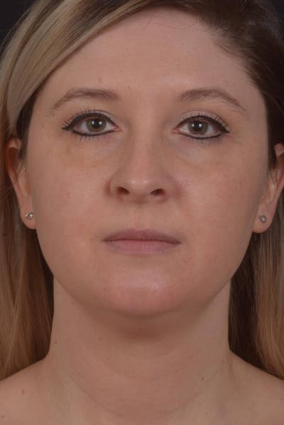 Neck Liposuction Before & After Gallery - Patient 427045 - Image 1